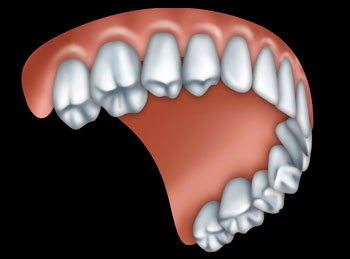 A Full Upper Denture